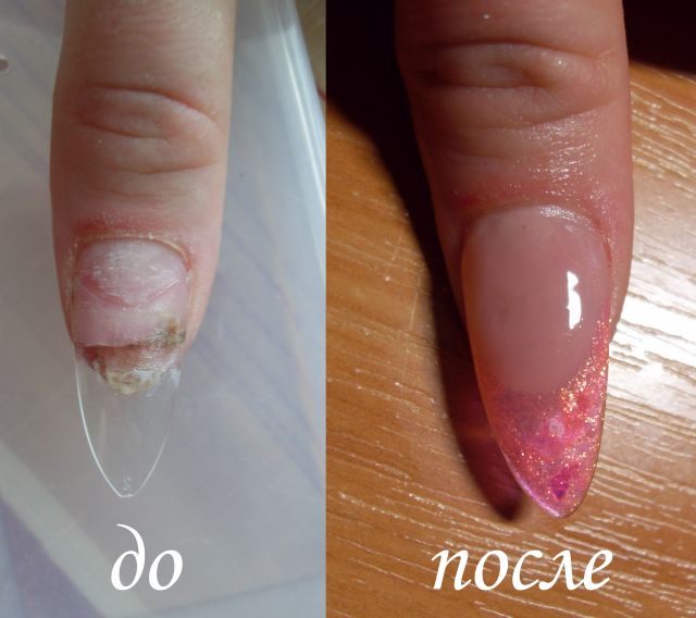 Чем можно отклеить ногти Чем можно отклеить ногти